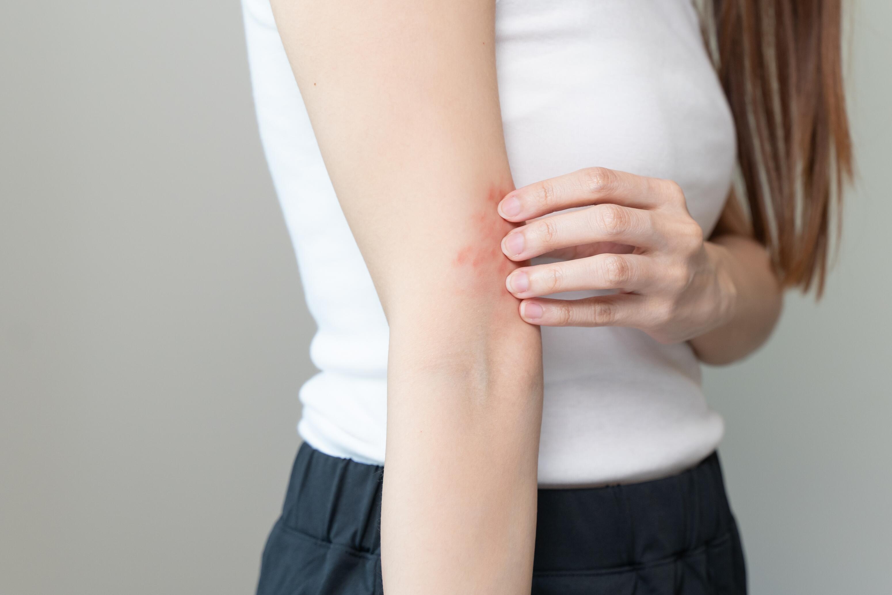 eczema sull’avambraccio